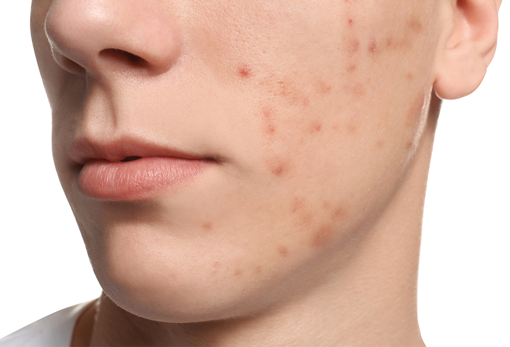 にきび・にきび痕