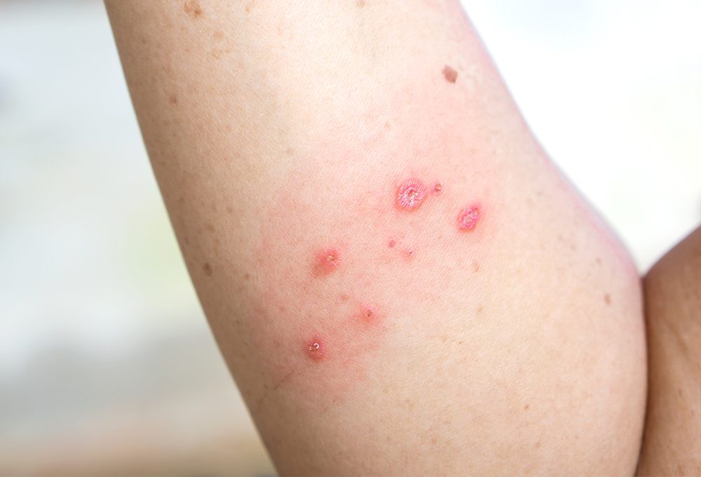 湿疹・かぶれ・じんましん