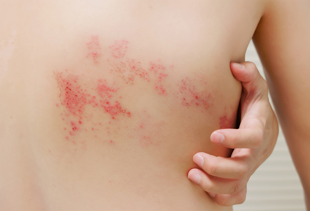 帯状疱疹・ヘルペス