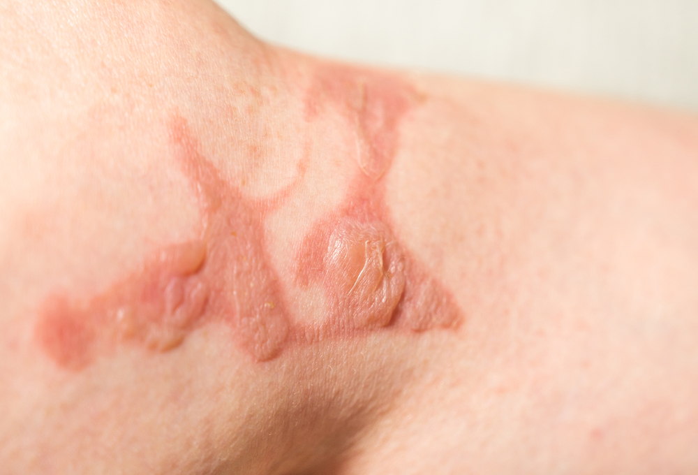 やけど・傷痕・ケロイド