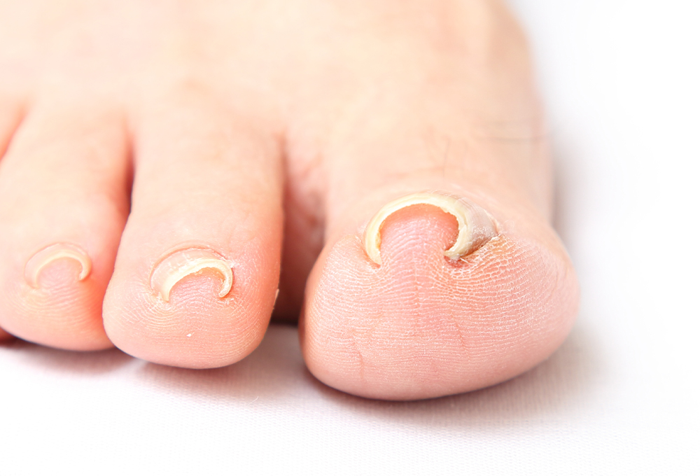 巻き爪・陥入爪