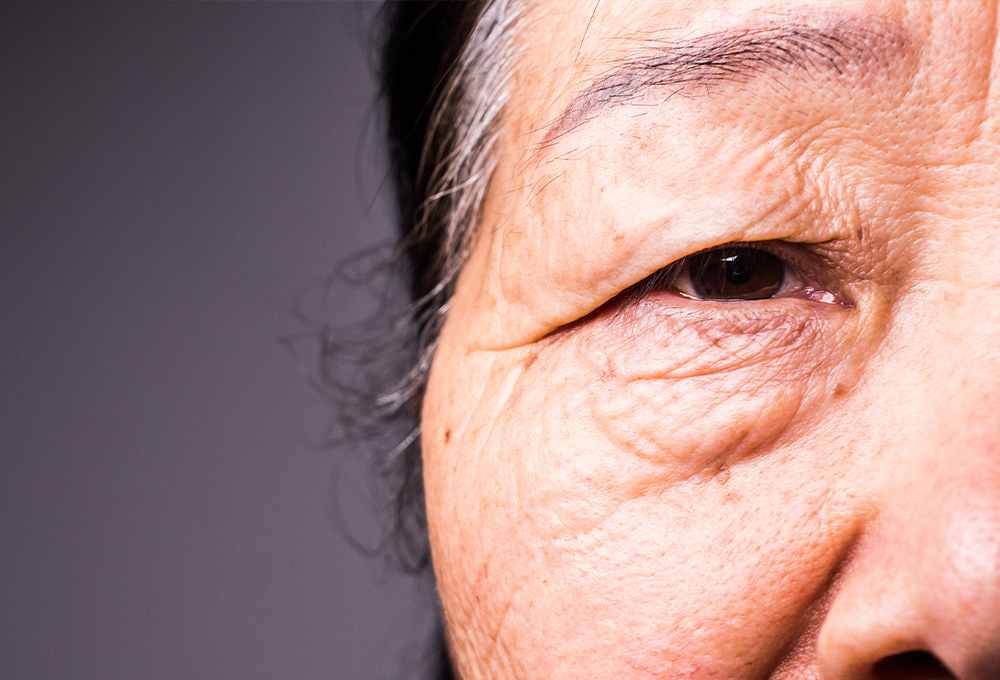 まぶた（眼瞼下垂・逆さまつ毛・眼瞼腫瘍）